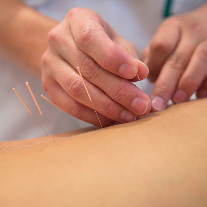 Treatment-by-acupuncture-RESIZED